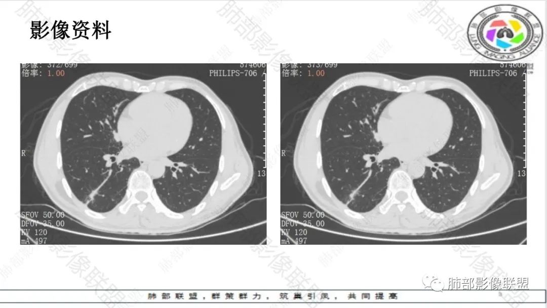 影像PPT - 【病例】最常见的肺部条片影—“尖角”定乾坤-15 影像PPT - 【病例】最常见的肺部条片影—“尖角”定乾坤-15