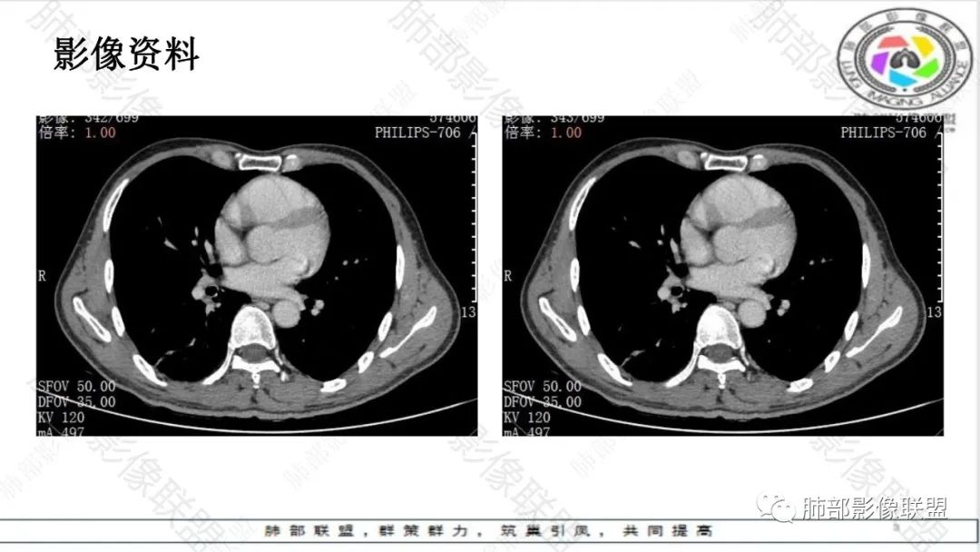 影像PPT - 【病例】最常见的肺部条片影—“尖角”定乾坤-18 影像PPT - 【病例】最常见的肺部条片影—“尖角”定乾坤-18