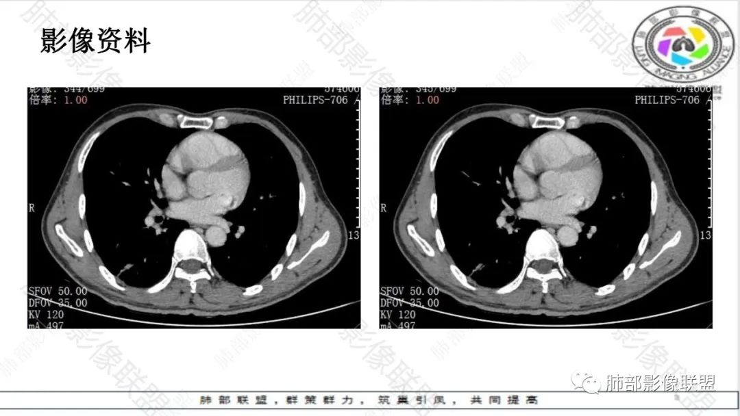 影像PPT - 【病例】最常见的肺部条片影—“尖角”定乾坤-19 影像PPT - 【病例】最常见的肺部条片影—“尖角”定乾坤-19