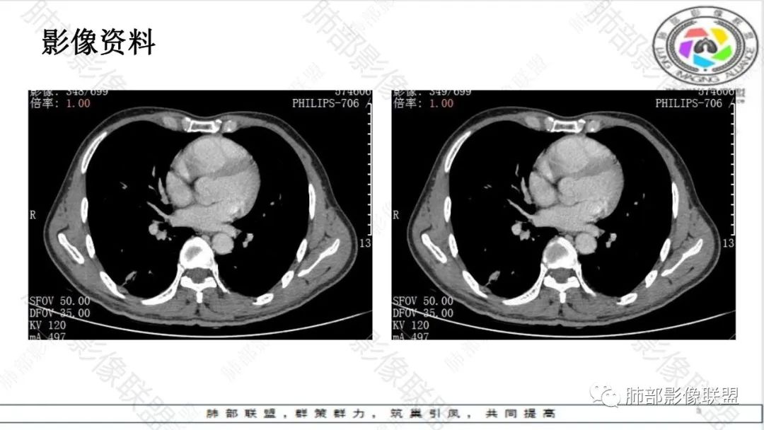 影像PPT - 【病例】最常见的肺部条片影—“尖角”定乾坤-21 影像PPT - 【病例】最常见的肺部条片影—“尖角”定乾坤-21