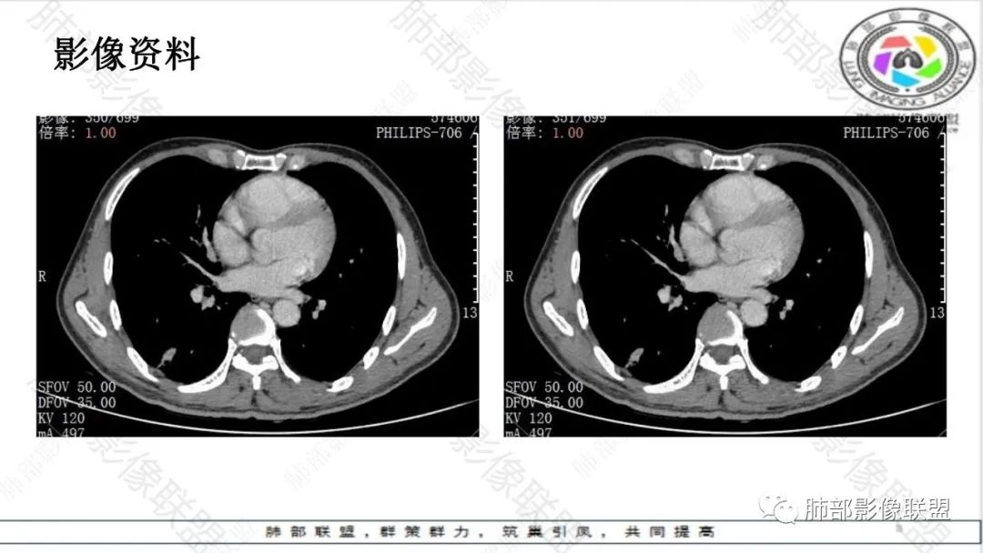 影像PPT - 【病例】最常见的肺部条片影—“尖角”定乾坤-22 影像PPT - 【病例】最常见的肺部条片影—“尖角”定乾坤-22