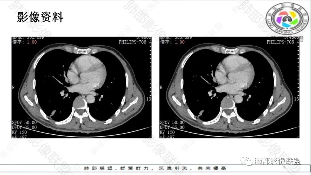 影像PPT - 【病例】最常见的肺部条片影—“尖角”定乾坤-23 影像PPT - 【病例】最常见的肺部条片影—“尖角”定乾坤-23