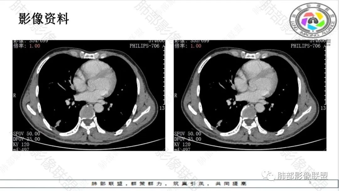 影像PPT - 【病例】最常见的肺部条片影—“尖角”定乾坤-24 影像PPT - 【病例】最常见的肺部条片影—“尖角”定乾坤-24