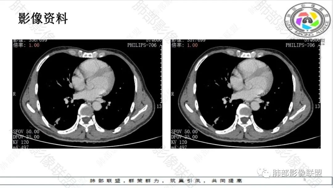 影像PPT - 【病例】最常见的肺部条片影—“尖角”定乾坤-25 影像PPT - 【病例】最常见的肺部条片影—“尖角”定乾坤-25