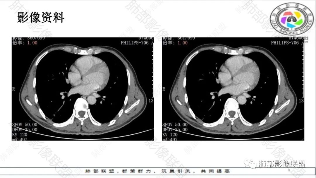 影像PPT - 【病例】最常见的肺部条片影—“尖角”定乾坤-27 影像PPT - 【病例】最常见的肺部条片影—“尖角”定乾坤-27