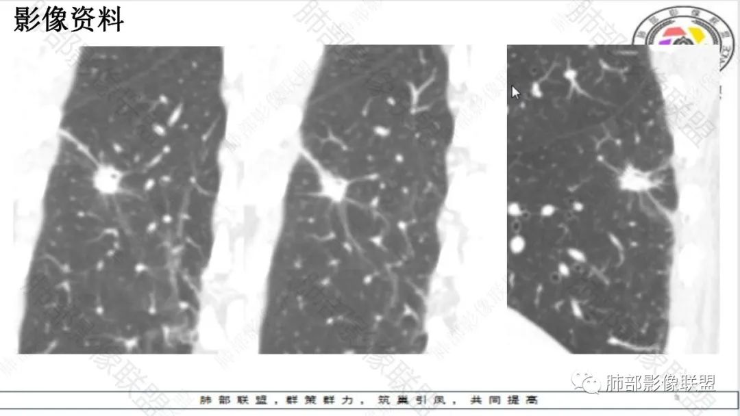 影像PPT - 【病例】最常见的肺部条片影—“尖角”定乾坤-28 影像PPT - 【病例】最常见的肺部条片影—“尖角”定乾坤-28