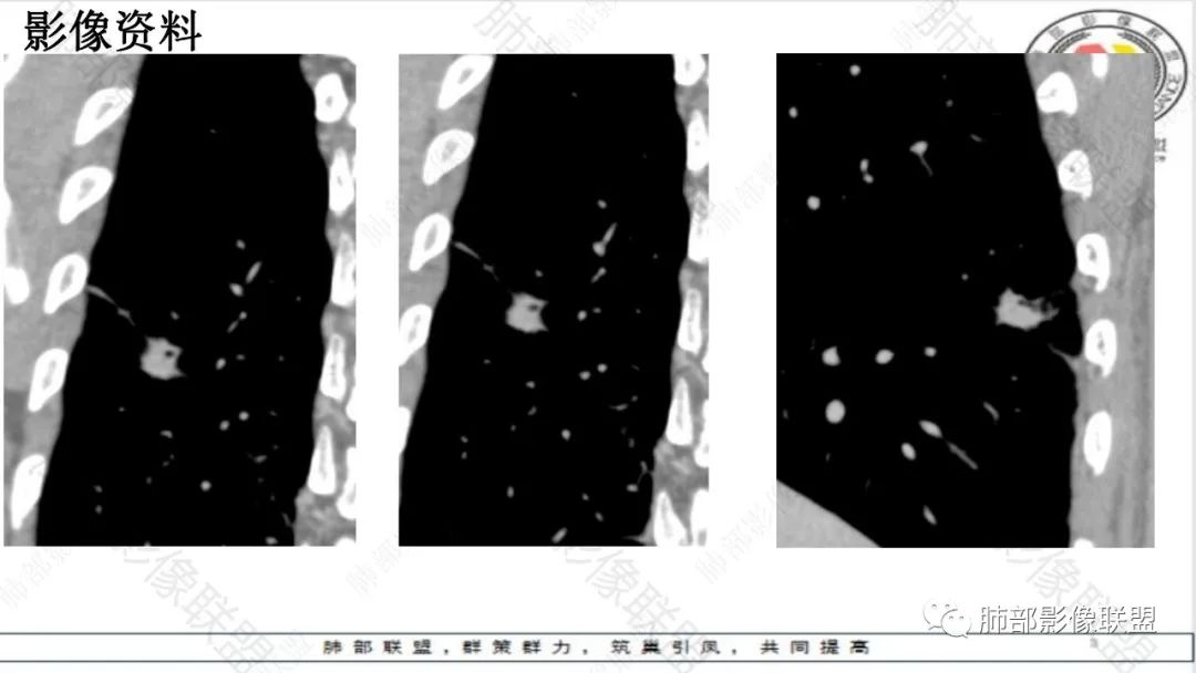 影像PPT - 【病例】最常见的肺部条片影—“尖角”定乾坤-29 影像PPT - 【病例】最常见的肺部条片影—“尖角”定乾坤-29
