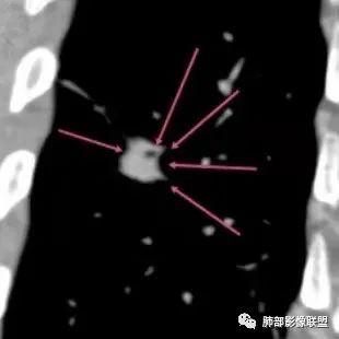 影像PPT - 【病例】最常见的肺部条片影—“尖角”定乾坤-32 影像PPT - 【病例】最常见的肺部条片影—“尖角”定乾坤-32