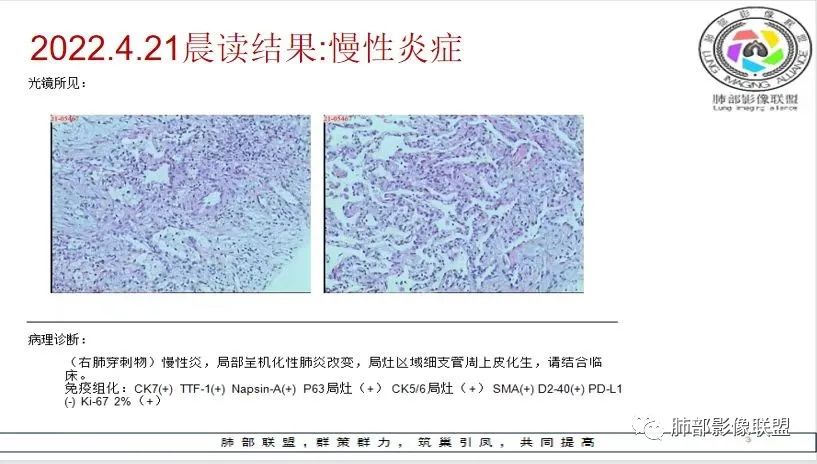 影像PPT - 【病例】最常见的肺部条片影—“尖角”定乾坤-33 影像PPT - 【病例】最常见的肺部条片影—“尖角”定乾坤-33