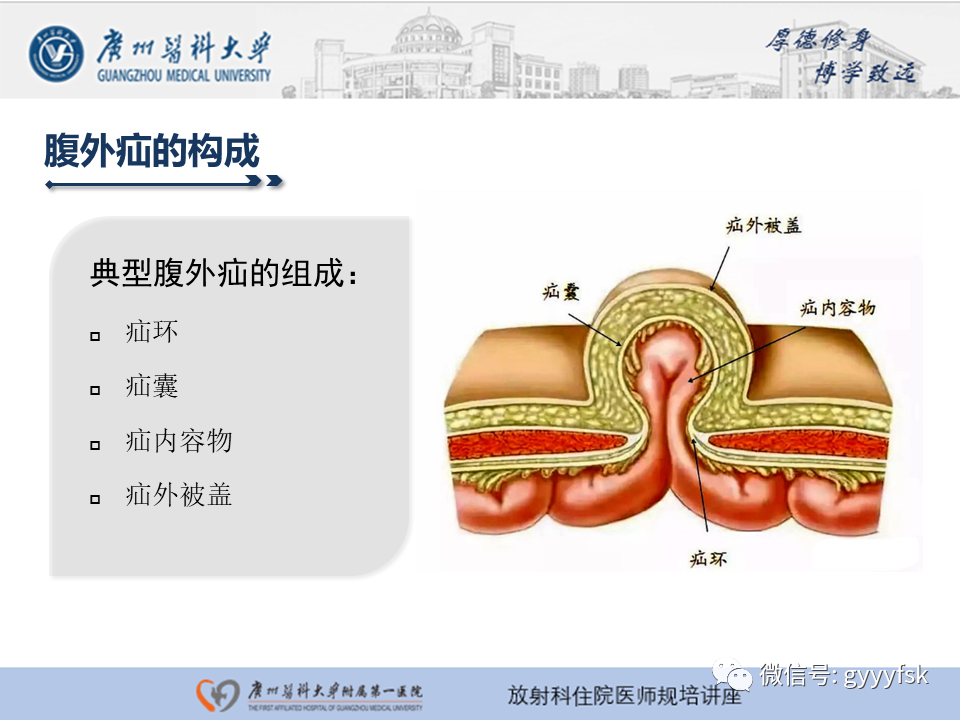 影像PPT - 【PPT】腹外疝的影像诊断-5