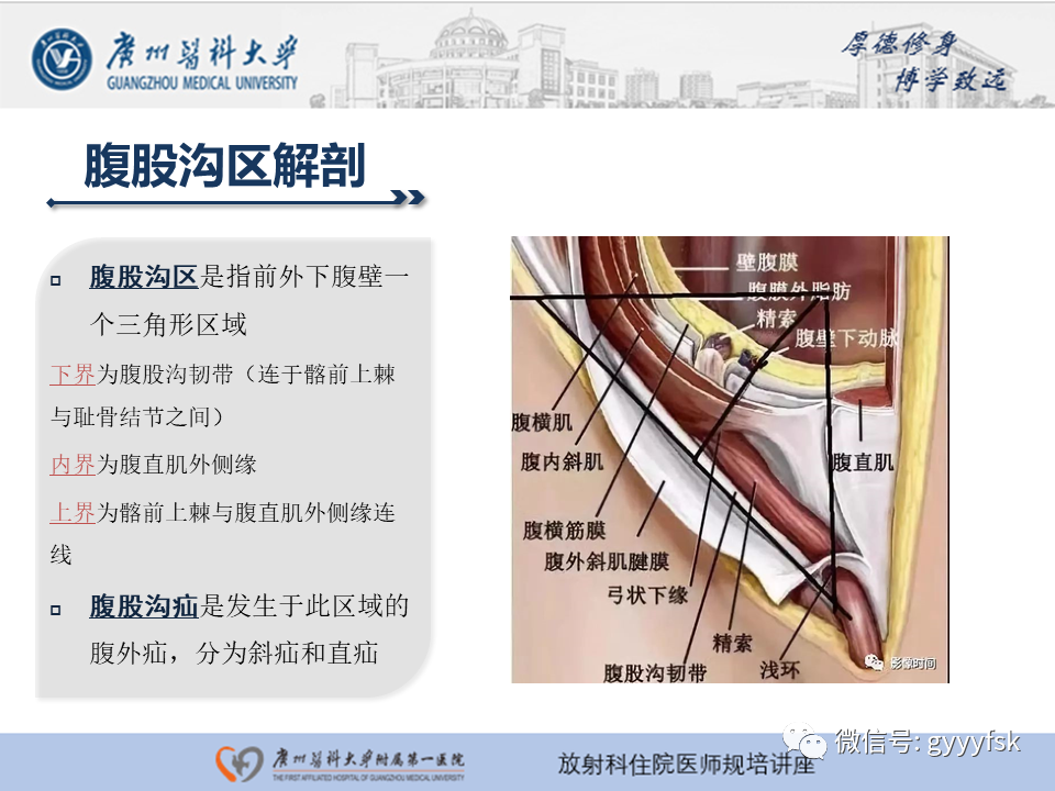 影像PPT - 【PPT】腹外疝的影像诊断-13