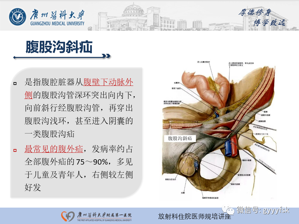 影像PPT - 【PPT】腹外疝的影像诊断-14