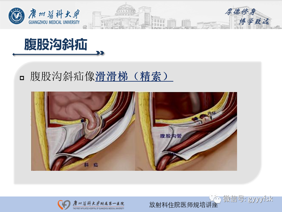影像PPT - 【PPT】腹外疝的影像诊断-15