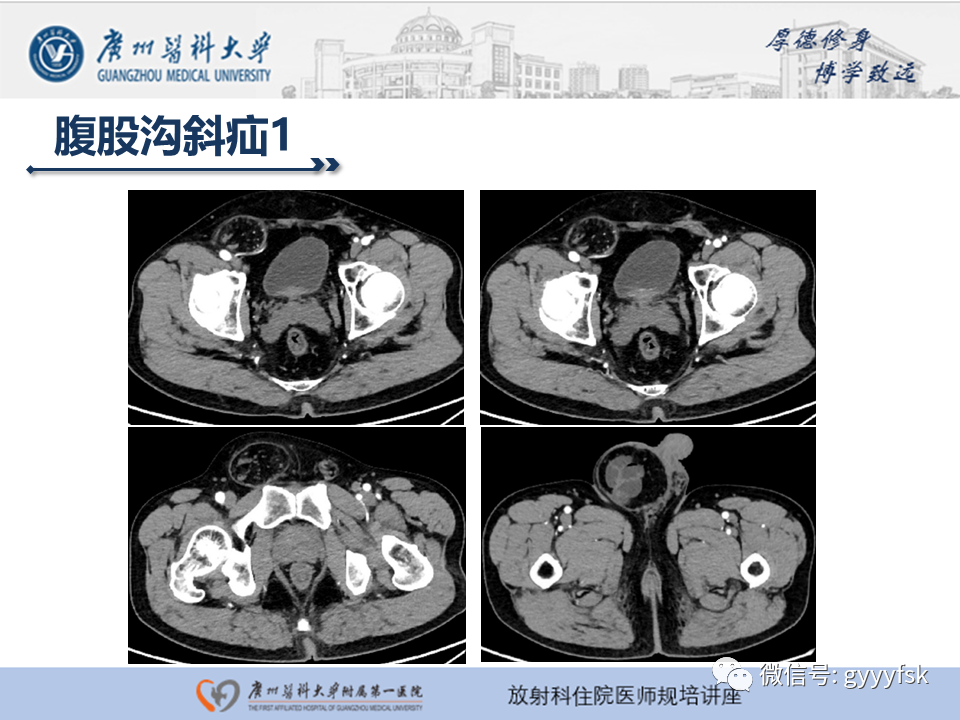 影像PPT - 【PPT】腹外疝的影像诊断-17