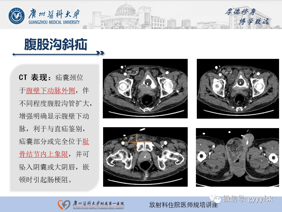 影像PPT - 【PPT】腹外疝的影像诊断-16