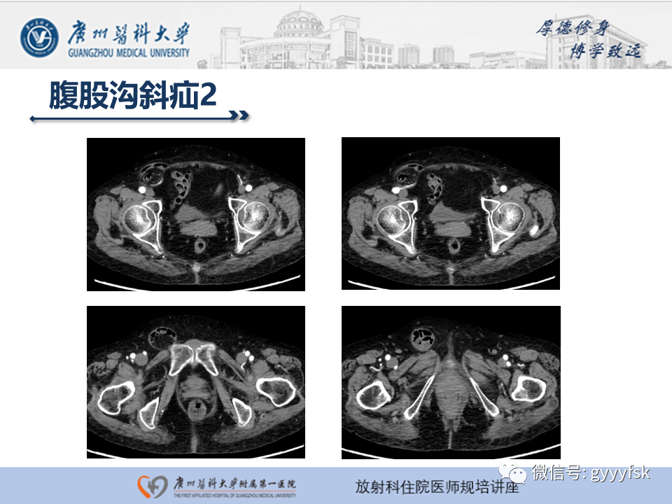 影像PPT - 【PPT】腹外疝的影像诊断-18