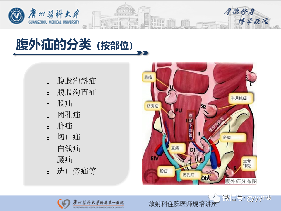影像PPT - 【PPT】腹外疝的影像诊断-6