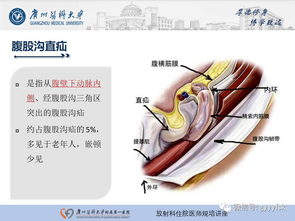 影像PPT - 【PPT】腹外疝的影像诊断-20