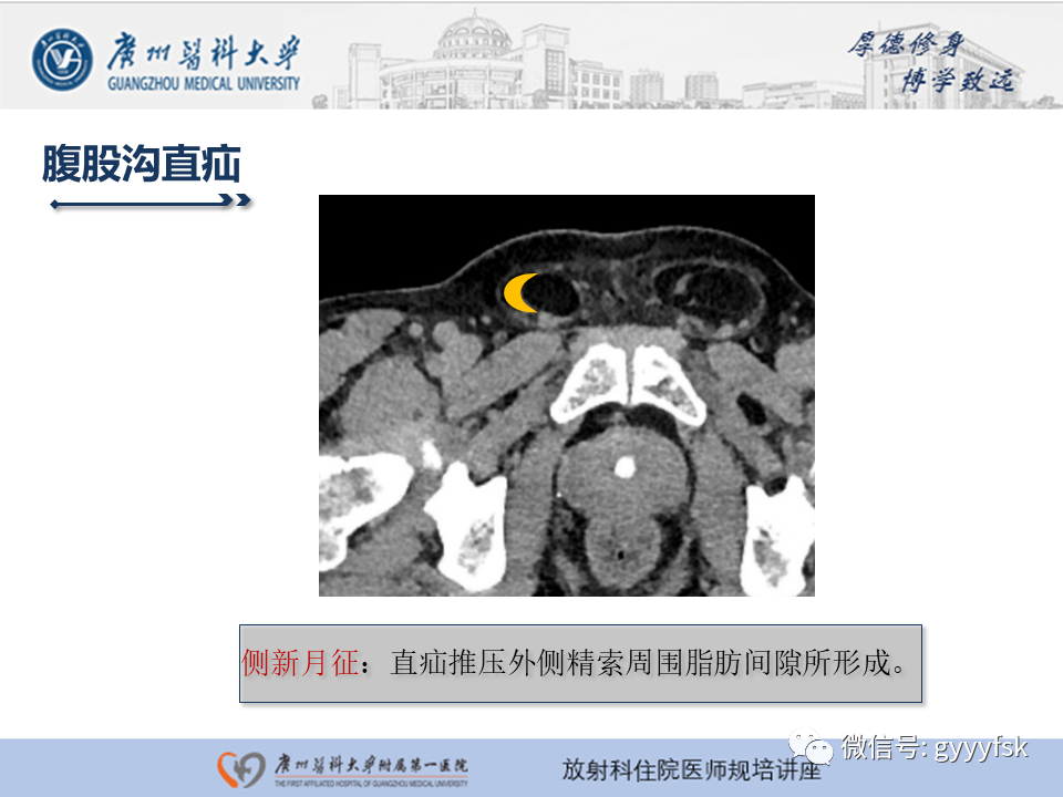 影像PPT - 【PPT】腹外疝的影像诊断-23