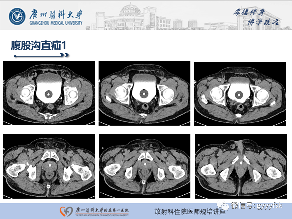 影像PPT - 【PPT】腹外疝的影像诊断-24