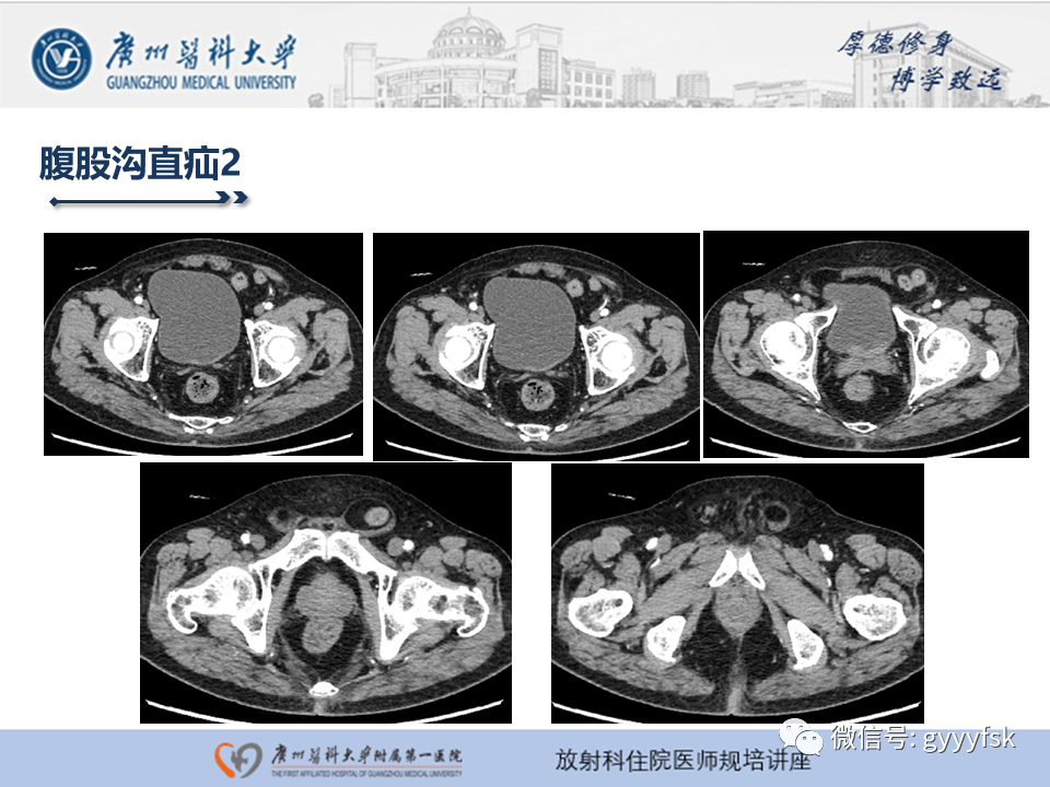影像PPT - 【PPT】腹外疝的影像诊断-25