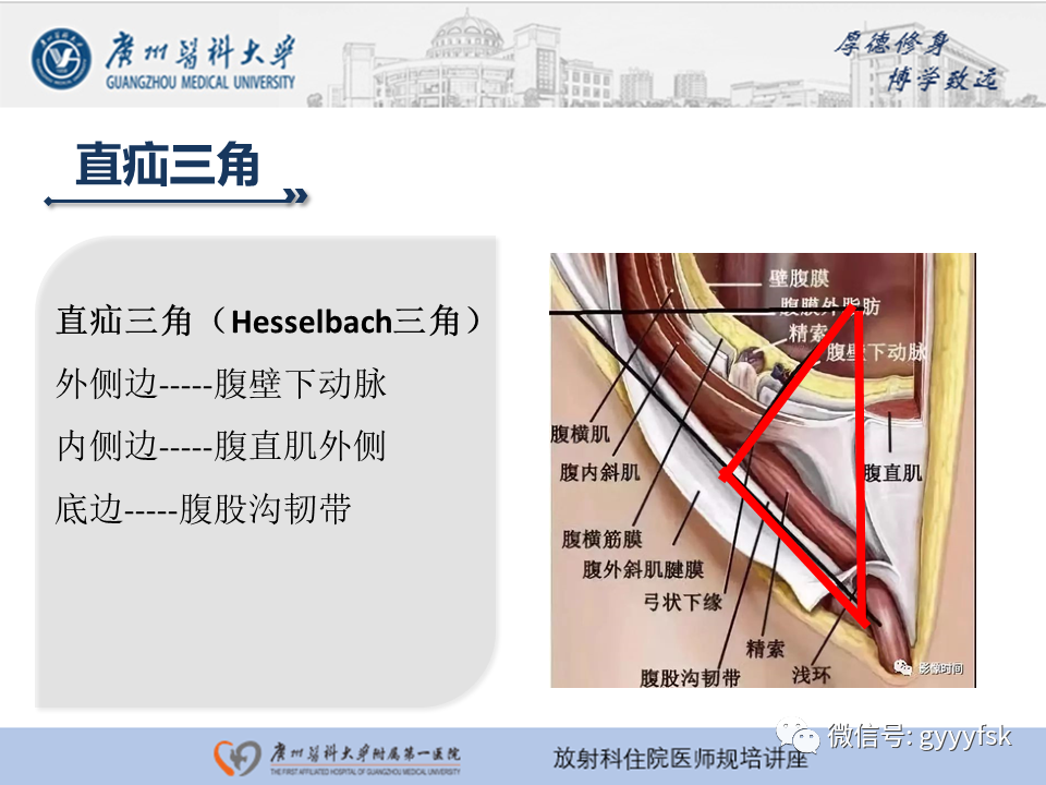 影像PPT - 【PPT】腹外疝的影像诊断-21