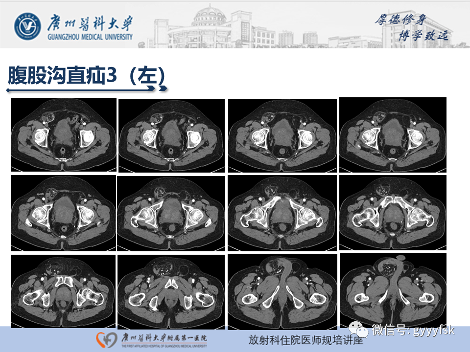 影像PPT - 【PPT】腹外疝的影像诊断-26