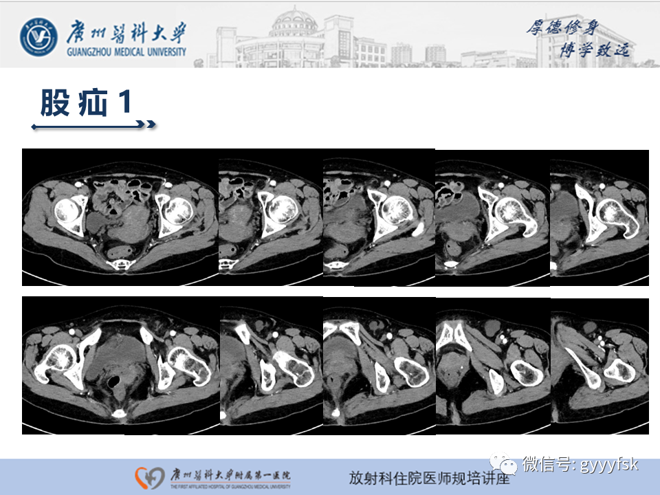 影像PPT - 【PPT】腹外疝的影像诊断-30