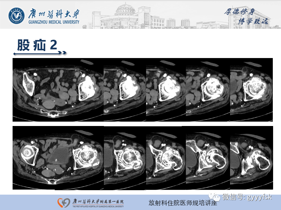 影像PPT - 【PPT】腹外疝的影像诊断-31