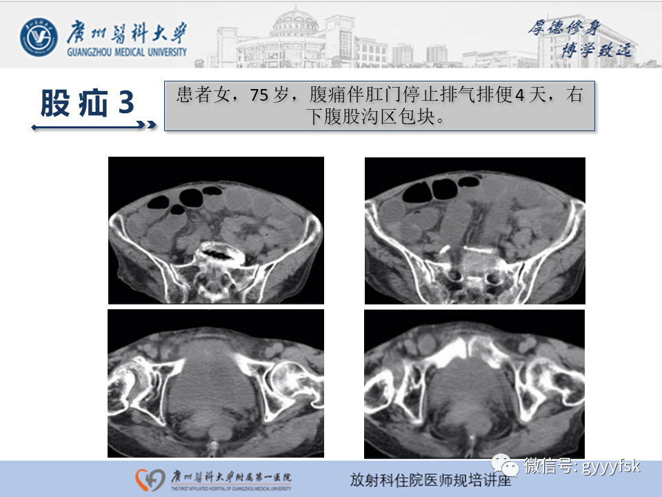 影像PPT - 【PPT】腹外疝的影像诊断-32