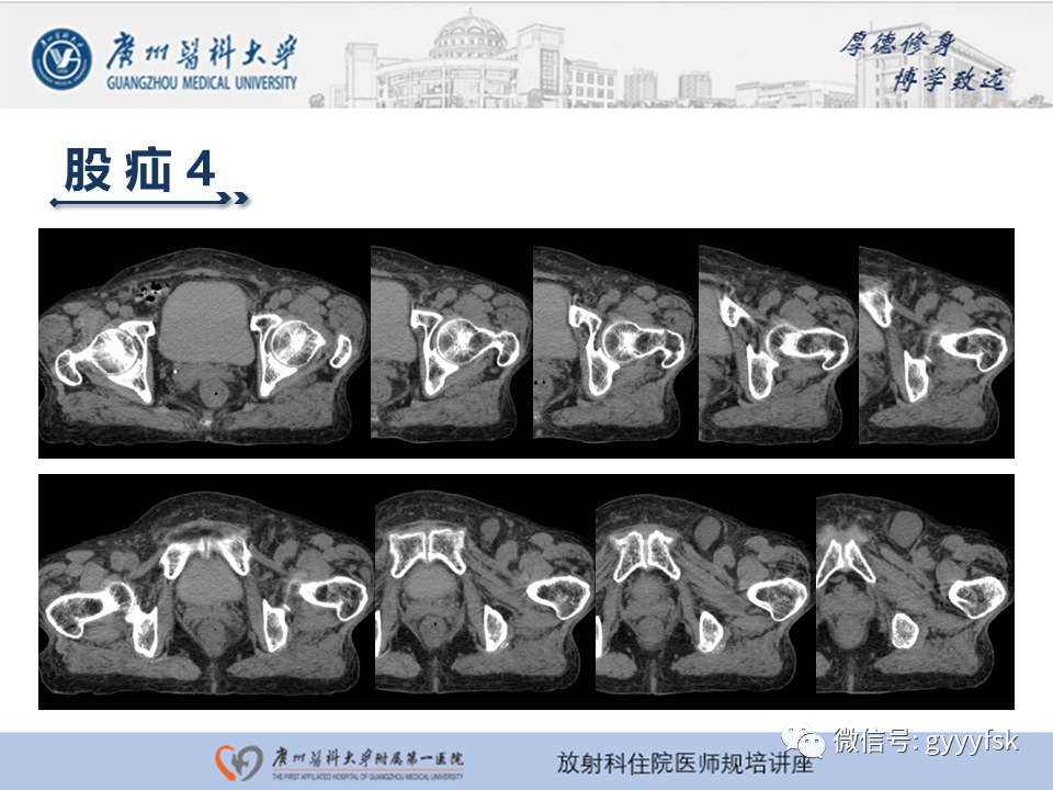 影像PPT - 【PPT】腹外疝的影像诊断-33