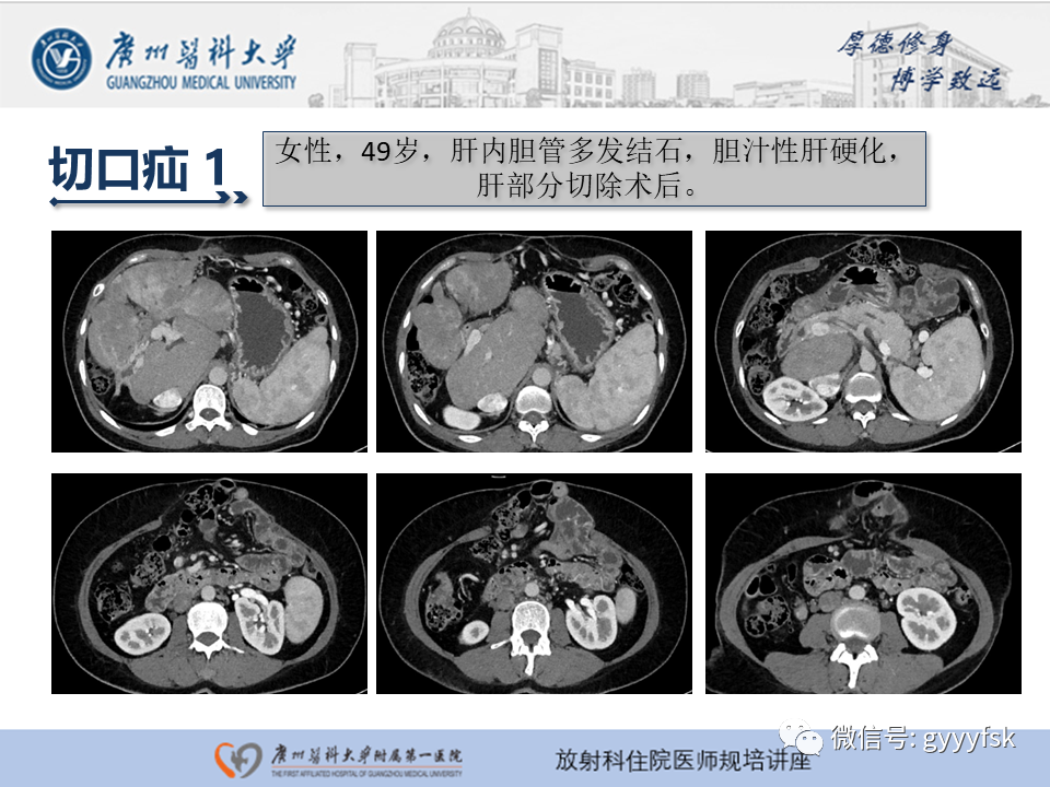 影像PPT - 【PPT】腹外疝的影像诊断-36