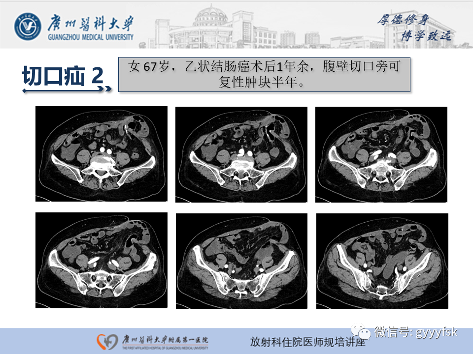 影像PPT - 【PPT】腹外疝的影像诊断-37