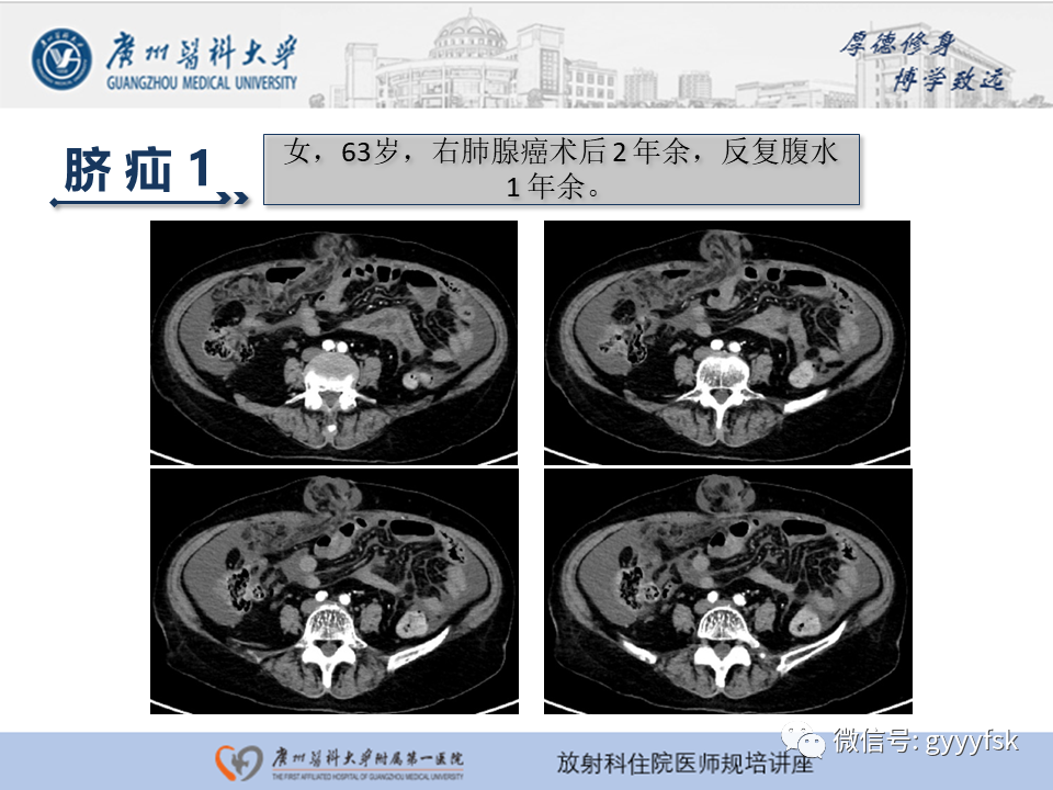 影像PPT - 【PPT】腹外疝的影像诊断-40