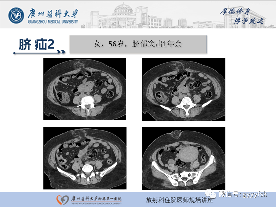影像PPT - 【PPT】腹外疝的影像诊断-41