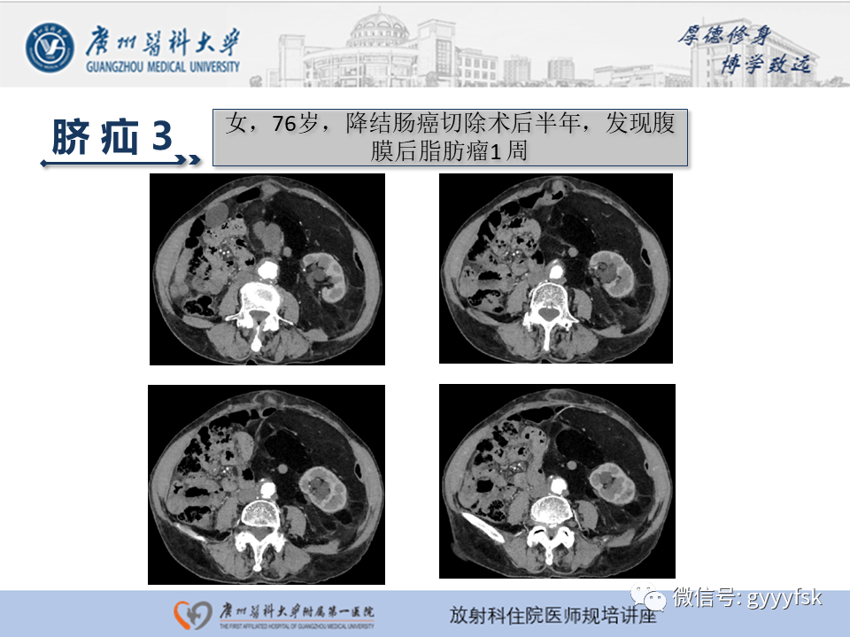 影像PPT - 【PPT】腹外疝的影像诊断-42