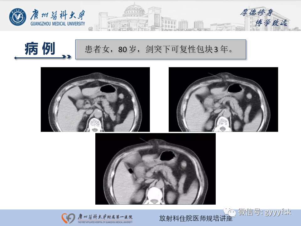 影像PPT - 【PPT】腹外疝的影像诊断-45