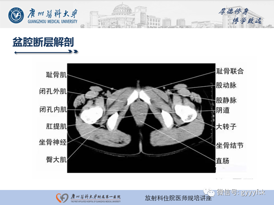 影像PPT - 【PPT】腹外疝的影像诊断-48