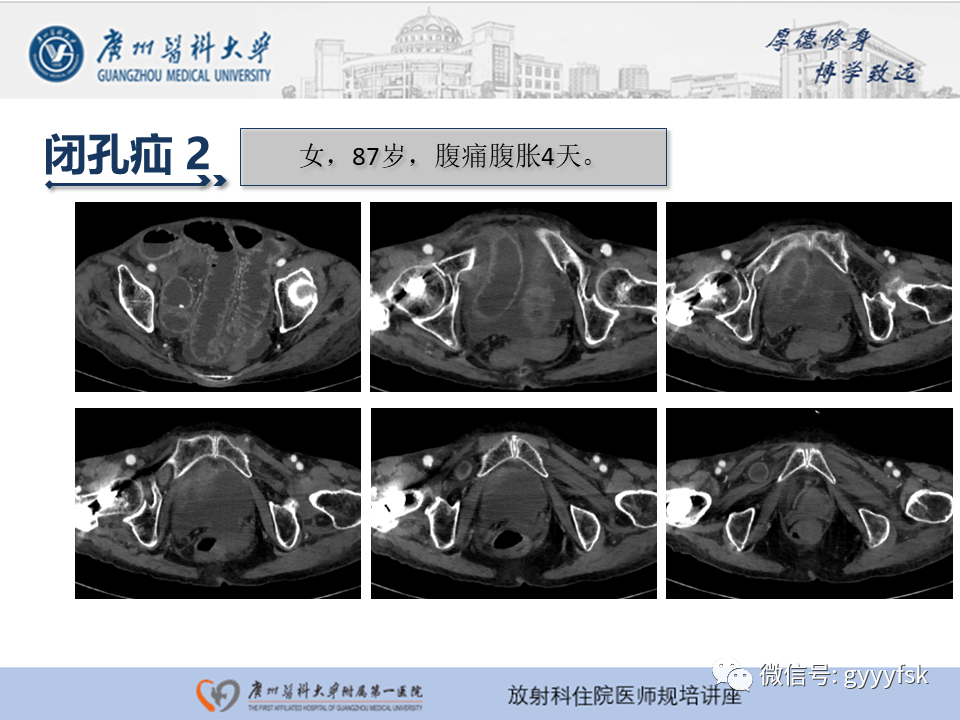 影像PPT - 【PPT】腹外疝的影像诊断-50