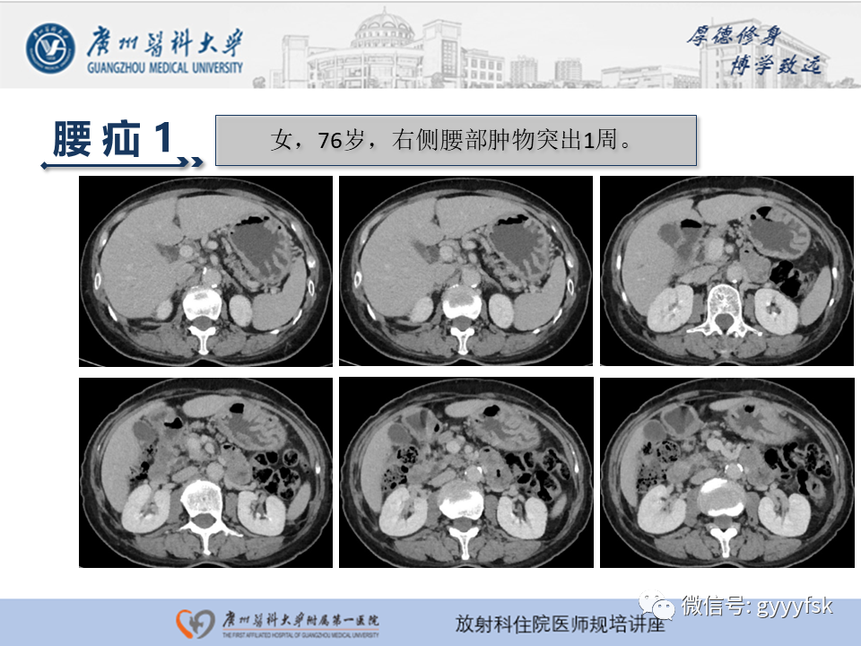 影像PPT - 【PPT】腹外疝的影像诊断-53