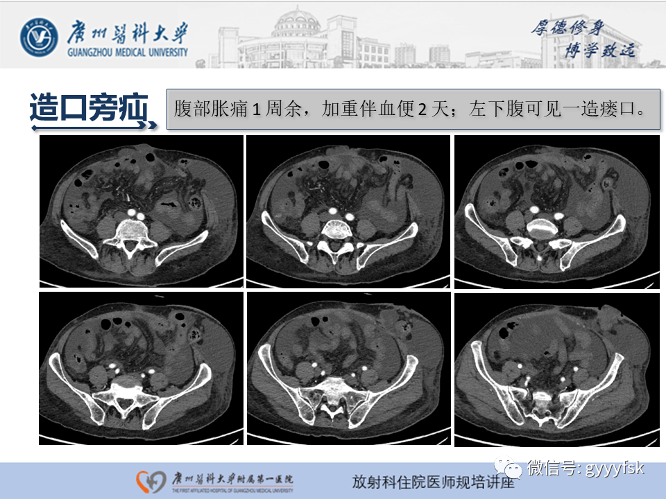 影像PPT - 【PPT】腹外疝的影像诊断-57