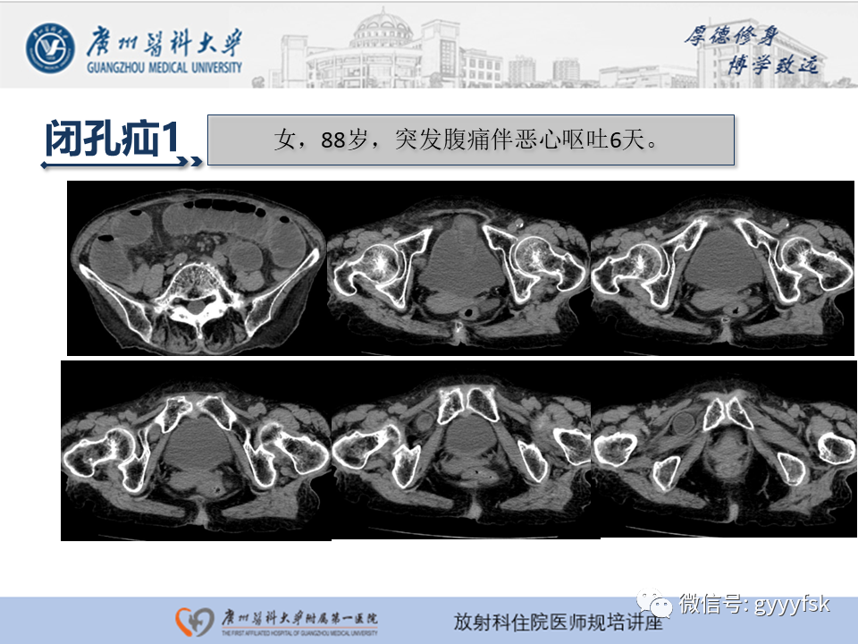 影像PPT - 【PPT】腹外疝的影像诊断-49