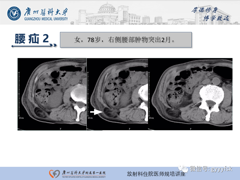 影像PPT - 【PPT】腹外疝的影像诊断-54