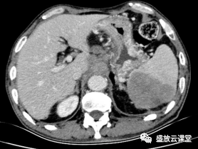 影像PPT - 【病例】脾脏淋巴瘤1例CT影像鉴别诊断-5 影像PPT - 【病例】脾脏淋巴瘤1例CT影像鉴别诊断-5