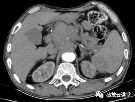 影像PPT - 【病例】脾脏淋巴瘤1例CT影像鉴别诊断-4 影像PPT - 【病例】脾脏淋巴瘤1例CT影像鉴别诊断-4