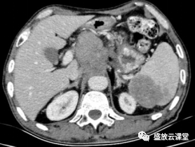 影像PPT - 【病例】脾脏淋巴瘤1例CT影像鉴别诊断-6 影像PPT - 【病例】脾脏淋巴瘤1例CT影像鉴别诊断-6