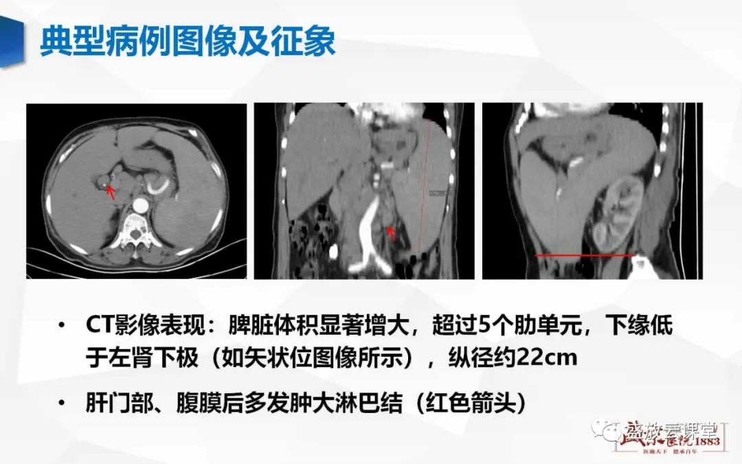 影像PPT - 【病例】脾脏淋巴瘤1例CT影像鉴别诊断-12 影像PPT - 【病例】脾脏淋巴瘤1例CT影像鉴别诊断-12