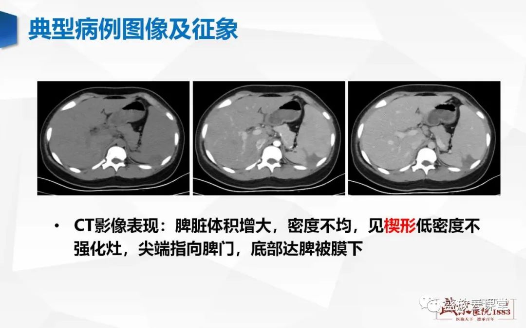 影像PPT - 【病例】脾脏淋巴瘤1例CT影像鉴别诊断-18 影像PPT - 【病例】脾脏淋巴瘤1例CT影像鉴别诊断-18
