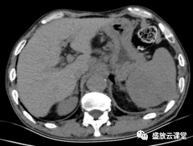 影像PPT - 【病例】脾脏淋巴瘤1例CT影像鉴别诊断-1 影像PPT - 【病例】脾脏淋巴瘤1例CT影像鉴别诊断-1