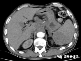 影像PPT - 【病例】脾脏淋巴瘤1例CT影像鉴别诊断-3 影像PPT - 【病例】脾脏淋巴瘤1例CT影像鉴别诊断-3